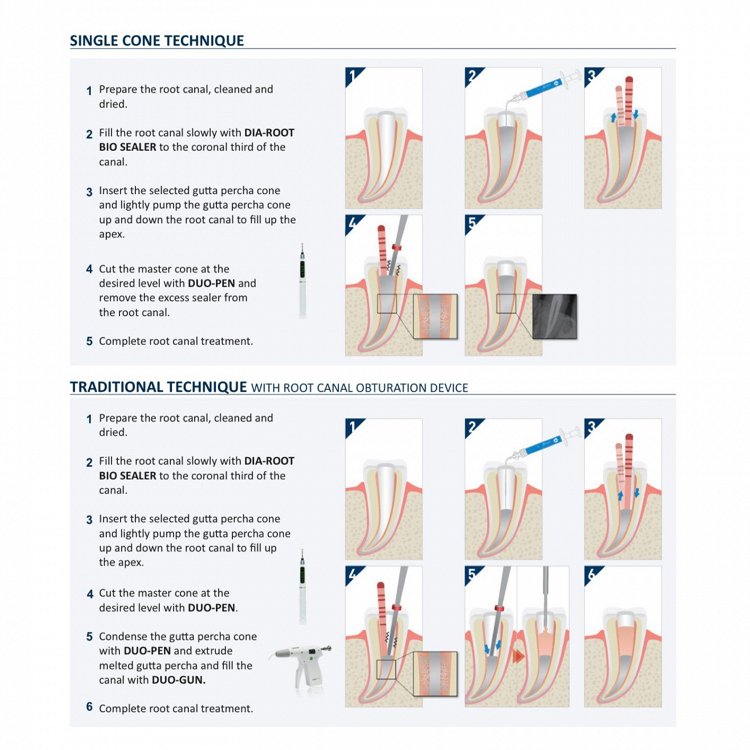 Diadent Dia-Root Bio Sealer