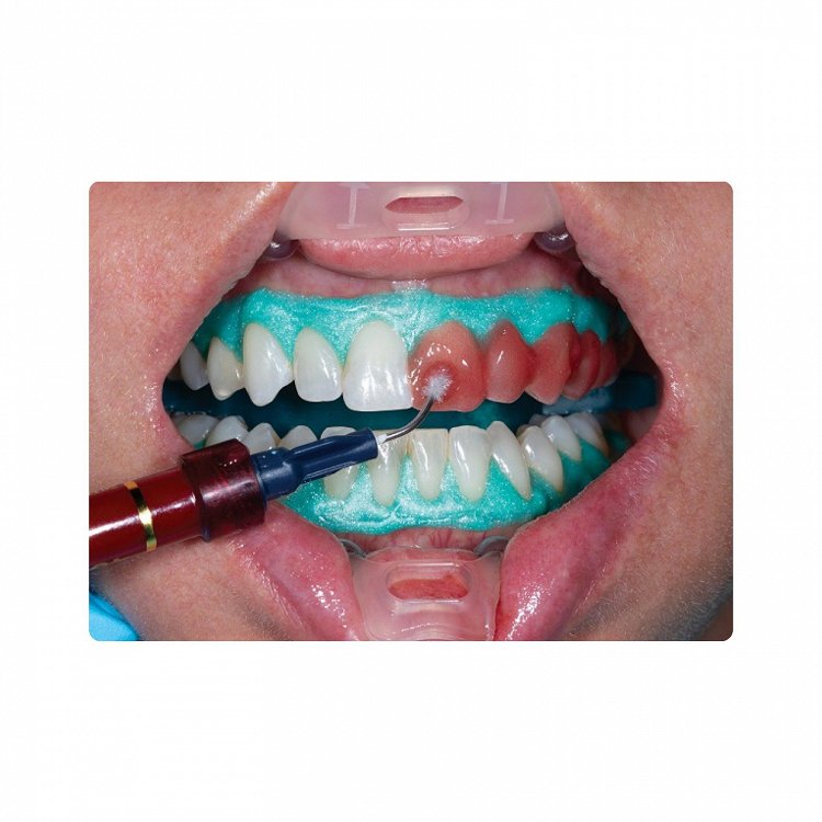 Ultradent Opalescence Boost 40%