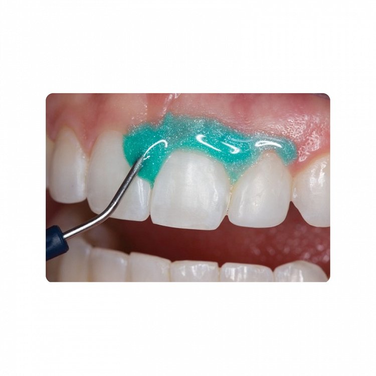 Ultradent OpalDam