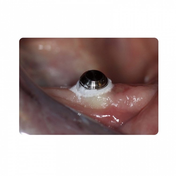 Ultradent Oraseal Kit
