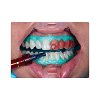 Ultradent Opalescence Boost 40%